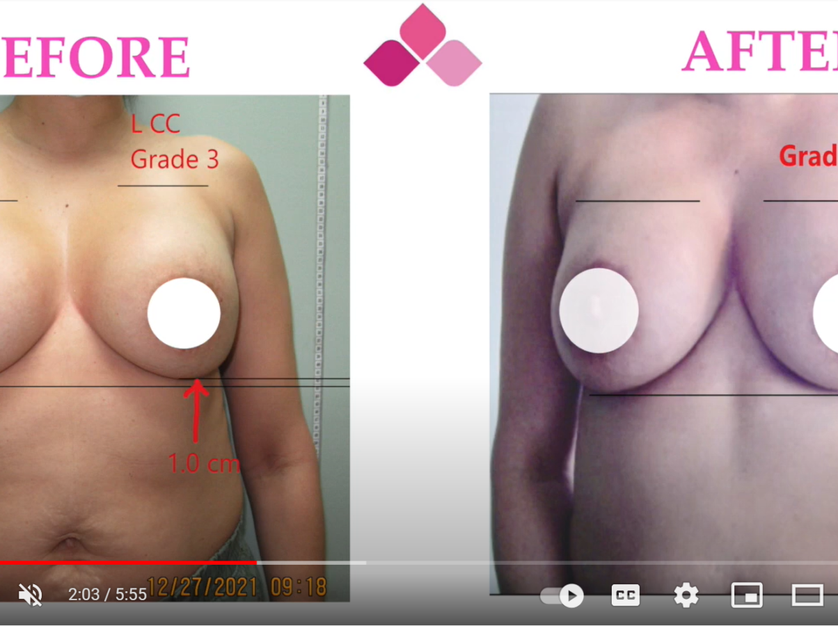 Breast reconstruction capsular contracture