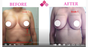 Breast reconstruction capsular contracture