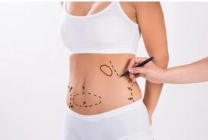 Liposuction Treatment
