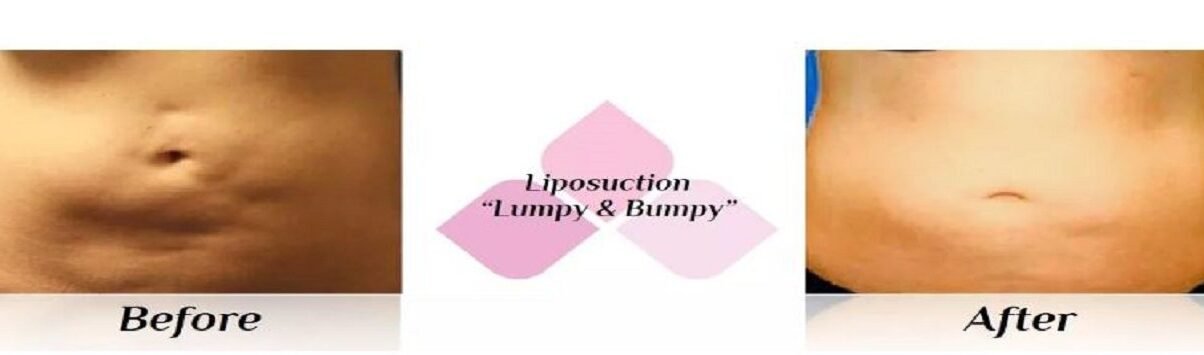 liposuction fibrosis