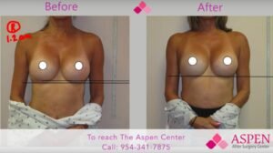 breast implant capsular contracture