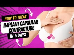 breast implant capsular contracture 